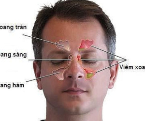 Chỉ đau đầu, giảm thị lực, đi khám đã phát hiện ung thư 'ăn' vào não