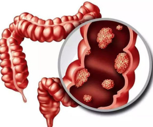 Bác sĩ cảnh báo 2 loại 'đau' báo hiệu ung thư ruột, 4 kiểu người nên đi khám sớm
