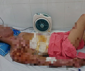 Thương tâm: Chuẩn bị ăn cơm thì nổ bình gas, cả gia đình 4 người bỏng nặng