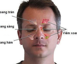 Bệnh ung thư 'ăn' vào não có dấu hiệu chỉ từ đau đầu, nhìn kém
