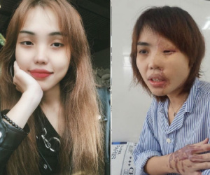 Cô gái bị thiếu uý CA tạt axit nói gì về tin 'bắt cá 2 tay'?