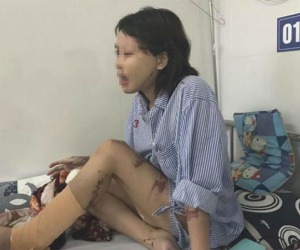 Vụ cô gái bị tạt axit: Bác sĩ ám ảnh vì một nửa khuôn mặt cháy đen