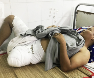 Đi làm thuê để lo cho vợ sắp sinh, chồng bị tai nạn nguy kịch phải cắt bỏ 1 chân