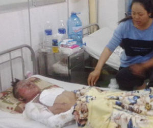 Vừa rút xăng vừa hút thuốc, nam thanh niên bị bỏng nặng
