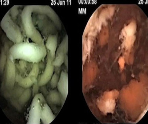 Mỳ ăn liền: Ăn sau 2 tiếng vẫn còn nguyên sợi trong dạ dày