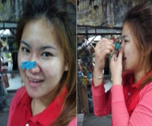 Thiếu nữ liều lĩnh tự dùng kẹp quần áo làm gọn mũi