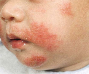 Cách nhận biết trẻ bị dị ứng sữa