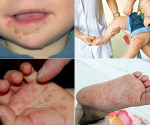 Có thể bị bệnh tay chân miệng nhiều lần?