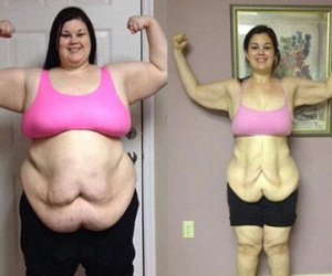 Phải phẫu thuật cắt da thừa vì giảm cân gần 100 kg