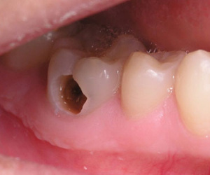 Mẹo giảm đau răng tại nhà không cần thuốc