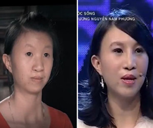 Ngỡ ngàng diện mạo mới của cô gái mang dị tật sứt môi hở hàm ếch