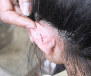 Cô giáo mầm non kéo tai làm trẻ bị thương