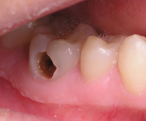 Răng hỏng gây hại đến cơ thể như thế nào?