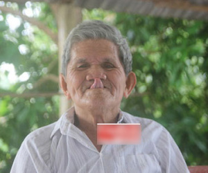 Khỏi câm điếc, cụ ông có khả năng đưa lưỡi tới mũi