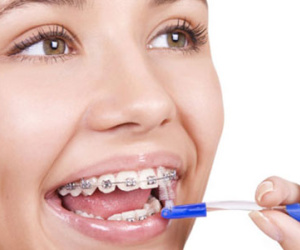 Niềng răng nguy hiểm thế nào?