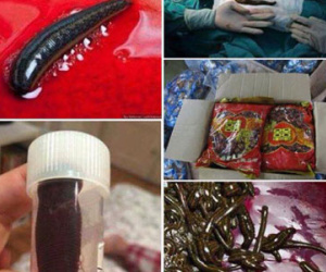Thực hư ca phẫu thuật toàn đỉa tại BV Bạch Mai