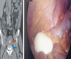 Phát hiện "quả trứng luộc" tồn tại 20 năm trong bụng người