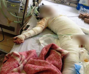 Bé gái 5 tuổi bỏng toàn thân do than văng vào người