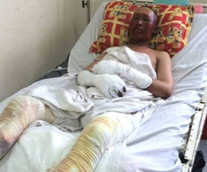 Nổ lò nung, 2 công nhân bị thép văng vào người