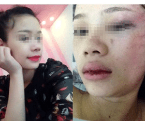 Thiếu nữ đăng ảnh kỷ niệm bị người yêu đánh lần thứ năm
