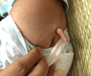 Bé gái 7 tháng tuổi mọc "đuôi"