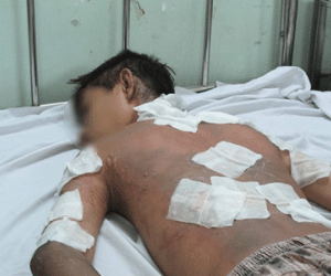 TP HCM: Nam sinh bị kẻ lạ tạt xăng đốt gần trường
