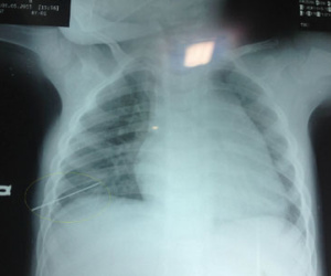 Bé 3 tuổi bị thủng phổi vì kim đâm xuyên ngực