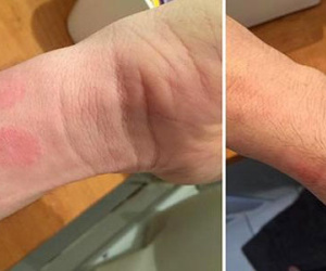 Người dùng bị dị ứng da khi đeo Apple Watch