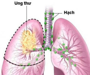 Ung thư phổi không phải là bản án tử!