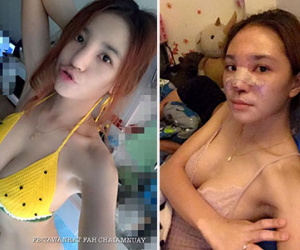 Hot girl Thái hóa “mặt quỷ” vì sự cố tiêm silicon