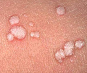 Nghiệt ngã chuyện ô sin bị sùi mào gà lây bệnh cho cả ông bà chủ