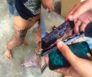 iPhone phát nổ trong túi quần vì nắng nóng, nam thanh niên bị bỏng nặng