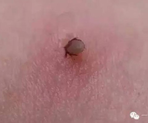 Kinh hãi con bọ ve "đào hầm" vào lưng bé trai 5 tuổi