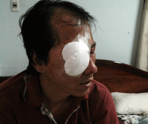 Tài xế bị ném đá trúng mắt kể lại đêm kinh hoàng