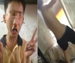 Phẫn nộ cậu bé trầm cảm bị bạn đánh, nhét thuốc lá vào mũi