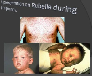 Rubella - Căn bệnh không thể xem nhẹ