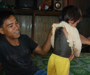Cô bé 4 tuổi có bộ lông dày suýt bị chôn sống