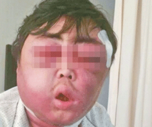 Mặt sưng phồng như quả bóng chỉ vì một vết... muỗi đốt