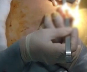 Thực hư về clip chất dịch vàng trào ra "ồ ạt" từ ngực thẩm mỹ hỏng