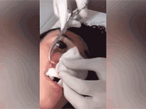 Môi sưng to như quả nho vì bị giòi 2cm đào hang làm tổ ở trong