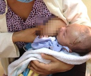 Bé trai bị đâm xuyên sọ ăn khỏe sau 3 ngày trở về nhà
