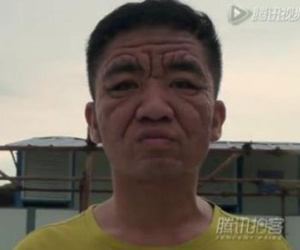 Bệnh lạ khiến chàng trai 30 tuổi già như ông cụ