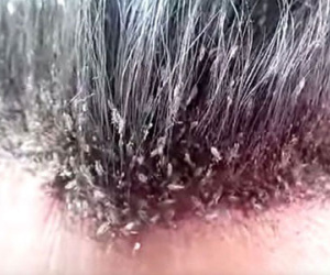 Đoạn video về chấy rận trên tóc khiến ai cũng phải nổi da gà