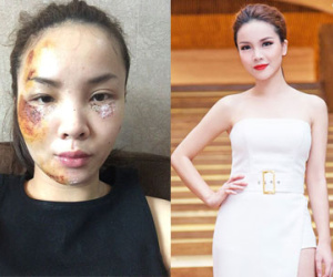 Sốc với khuôn mặt Yến Trang khi gặp tai nạn giao thông