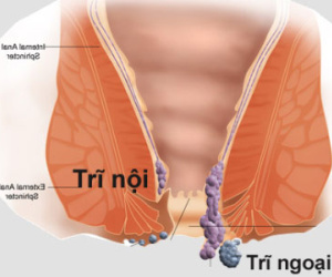Cảnh báo 30 - 50% người Việt mắc căn bệnh để lâu dễ thành ung thư