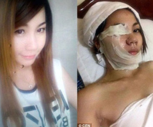 Tạt a-xít người yêu cũ, cô gái tự đốt cháy mặt mình