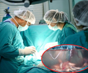 Kinh hãi giòi lúc nhúc trong đầu bệnh nhân