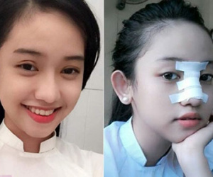 Thúy Vi- "bồ nhí" của Phan Thành công khai ảnh phẫu thuật thẩm mỹ