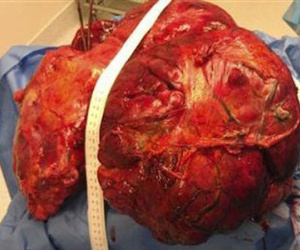 Phẫu thuật lấy khối u buồng trứng nặng đến 40 kg