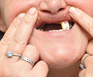 Tẩy trắng răng giá rẻ, rụng luôn răng cửa